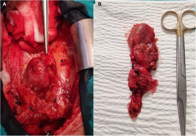 Case Report: Giant cholesterol granuloma in the anterior mediastinum